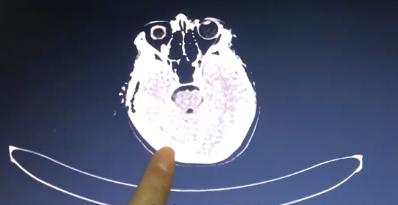 13岁男孩泡澡突发脑出血！医生提醒：热水久泡有风险(图2)